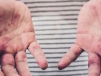 2025年宾州麻疹拉响警报，首例确诊于蒙哥马利县